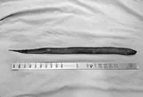 Người đàn ông 41 tuổi đau dữ dội, bác sĩ "sốc ngang" thấy con lươn dài 50cm trong bụng