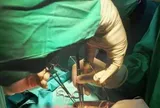 Bé trai 3 tuổi nôn ra giun, khi phẫu thuật bác sĩ phát hiện điều đáng sợ hơn