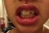 Bé gái lớp 5 bị gãy răng cửa, bố mẹ làm ngay 1 việc mà đến bệnh viện bác sĩ cũng phải khen: "Rất thông minh"