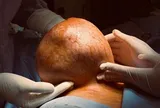 Mang "quả tạ" gần 4kg suốt nhiều năm, người phụ nữ bàng hoàng khi biết sự thật