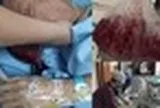 Người đàn ông nôn ra hơn 2 lít máu trong 5 phút, bác sĩ cảnh báo: 4 thói quen ăn uống "phá nát" dạ dày
