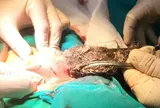 Phẫu thuật lấy búi tóc dài gần 20cm trong dạ dày bé trai 4 tuổi, do bé mắc bệnh lạ