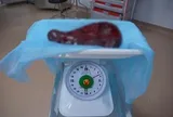 Bụng người đàn ông 69 tuổi ngày càng phình to, bác sĩ sững sờ khi phát hiện thứ "khổng lồ" bên trong