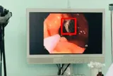 Ngậm đinh trong miệng, người đàn ông 50 tuổi gặp sự cố đáng sợ