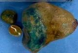 Đau bụng đến mức "đứng ngồi không yên", người đàn ông sốc khi biết sự thật