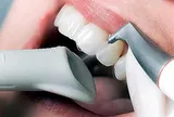 Vệ sinh răng sứ đúng cách để sau phục hình răng đảm bảo bền đẹp lâu dài