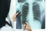 "Thủ phạm" gây xơ phổi không hồi phục, đôi khi tử vong nhanh hơn cả ung thư