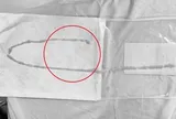Người phụ nữ 48 tuổi sốc khi bác sĩ gắp ra thứ "đáng sợ" bên trong bụng