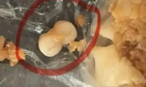 Liên tiếp phát hiện răng người trong xúc xích, dim sum: Người tiêu dùng 'sốc' đặt câu hỏi, nguyên liệu này từ đâu ra?