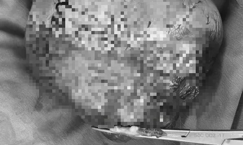 Đi siêu âm, người đàn ông sốc nặng khi thấy vật thể "lạ" khổng lồ trong ổ bụng