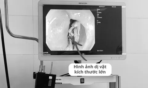 Bệnh nhân 16 tuổi đau họng kéo dài, bác sĩ phát biện bí mật "đáng sợ" bên trong