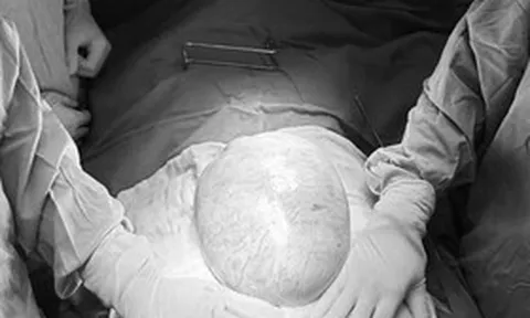 Bé gái 13 tuổi bụng to bất thường, bố mẹ sốc khi phát hiện bí mật "đáng sợ" bên trong