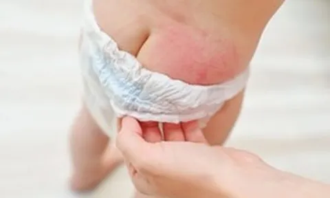 Rúng động: Phát hiện chất độc ảnh hưởng sinh sản trong hãng tã bỉm trẻ em Huggies, có thể ngấm vào máu và nước tiểu