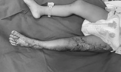 Bị rắn hổ mang cắn nguy kịch, bé 41 tháng tuổi được cứu sống ngoạn mục
