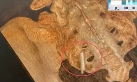 Đi khám sức khỏe, cô gái sốc khi phát hiện thứ "bất ngờ" nằm trong cơ thể suốt 22 năm