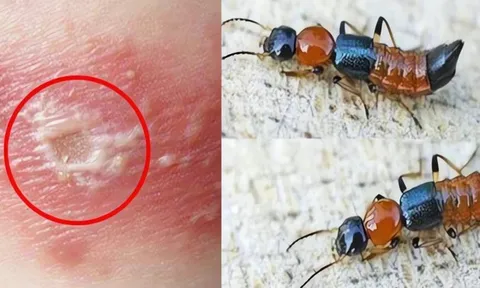 Kiến ba khoang "vào mùa", cẩn trọng dễ nhầm với zona thần kinh