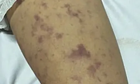 Xã Thường Tân, TP.HCM thông báo ghi nhận ca mắc não mô cầu ở trẻ 12 tuổi