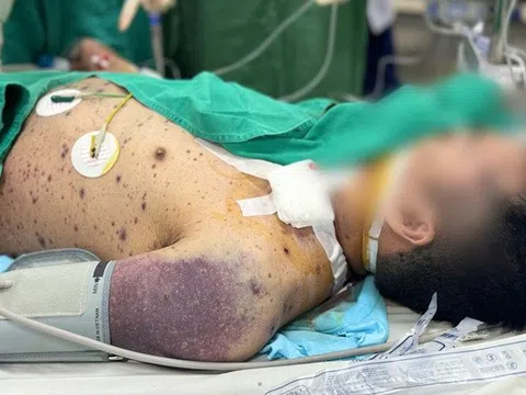 Hai nam thanh niên rơi vào nguy kịch vì biến chứng thủy đậu