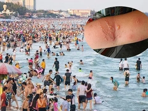 Người đàn ông bỏng rát toàn bộ chân trái sau 15 phút tắm biển