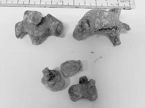 Đau quặn bụng dữ dội, người phụ nữ 55 tuổi phát hiện bí mật đáng sợ