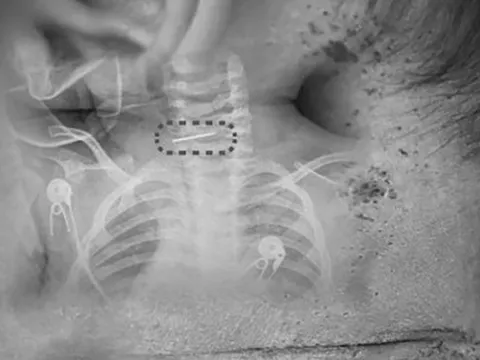 Bé trai bị sốt và co giật, bác sĩ phát hiện ra điều đáng sợ