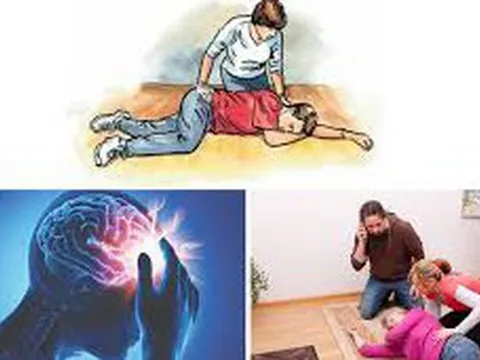 Đột quỵ não gia tăng và những dấu hiệu cảnh báo