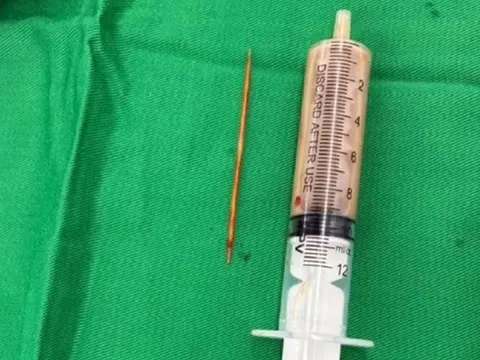 Người đàn ông bụng "cứng như đá" 2 tuần, bác sĩ phát hiện nguyên nhân bất ngờ