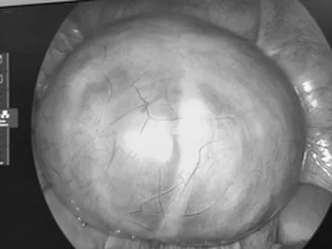 Đau bụng tưởng nhẹ, người phụ nữ sốc nặng khi bác sĩ lấy ra thứ “rợn người” trong cơ thể