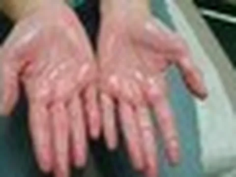 Khuyên thật: Thấy 5 thứ trên bàn tay phải đi khám thận ngay!