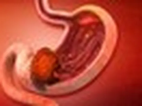 Ung thư dạ dày thường "để ý" tới những người có 5 thói quen này: Có 1 cũng phải bỏ ngay